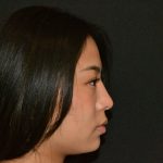 Rhinoplasty Before & After Patient #19860