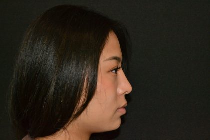 Rhinoplasty Before & After Patient #19860