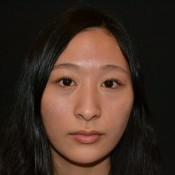 Rhinoplasty Before & After Patient #19859