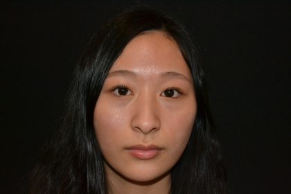 Rhinoplasty Before & After Patient #19859