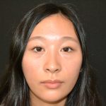 Rhinoplasty Before & After Patient #19859