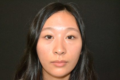 Rhinoplasty Before & After Patient #19859