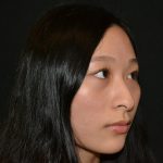 Rhinoplasty Before & After Patient #19859