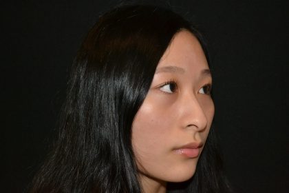 Rhinoplasty Before & After Patient #19859