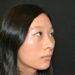 Rhinoplasty Before & After Patient #19859
