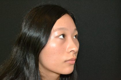 Rhinoplasty Before & After Patient #19859