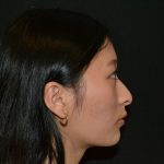 Rhinoplasty Before & After Patient #19859