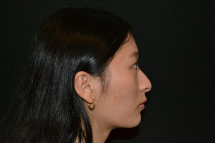 Rhinoplasty Before & After Patient #19859