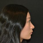 Rhinoplasty Before & After Patient #19859