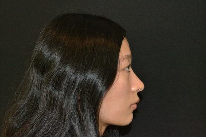 Rhinoplasty Before & After Patient #19859