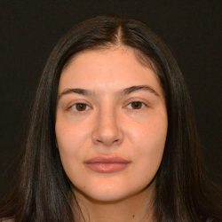 Rhinoplasty Before & After Patient #19861