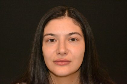 Rhinoplasty Before & After Patient #19861