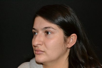 Rhinoplasty Before & After Patient #19861