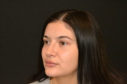 Rhinoplasty Before & After Patient #19861