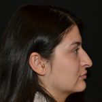 Rhinoplasty Before & After Patient #19861