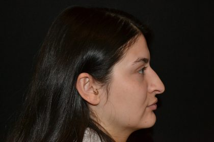 Rhinoplasty Before & After Patient #19861