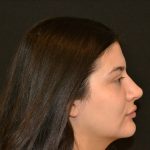 Rhinoplasty Before & After Patient #19861