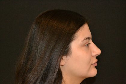 Rhinoplasty Before & After Patient #19861