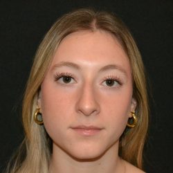 Rhinoplasty Before & After Patient #19842