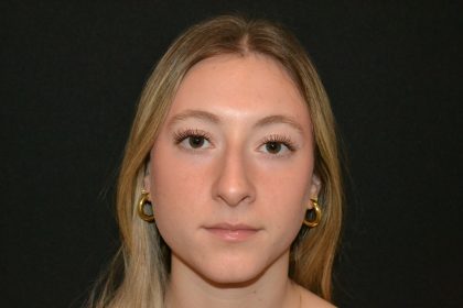 Rhinoplasty Before & After Patient #19842