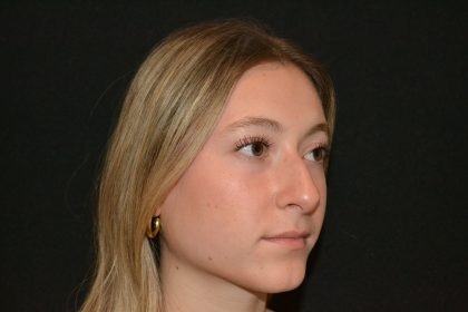 Rhinoplasty Before & After Patient #19842
