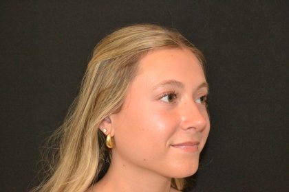 Rhinoplasty Before & After Patient #19842
