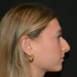 Rhinoplasty Before & After Patient #19842