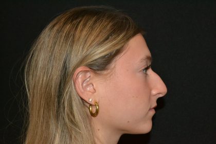 Rhinoplasty Before & After Patient #19842