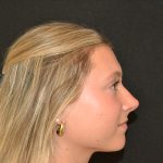 Rhinoplasty Before & After Patient #19842
