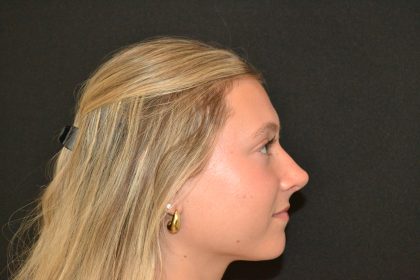 Rhinoplasty Before & After Patient #19842