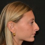 Rhinoplasty Before & After Patient #19843