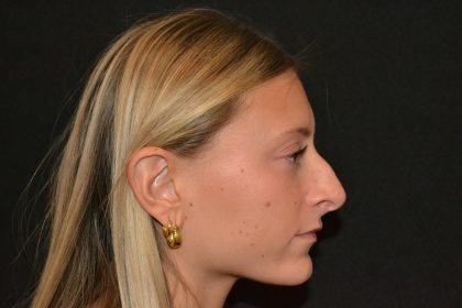 Rhinoplasty Before & After Patient #19843