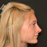 Rhinoplasty Before & After Patient #19843