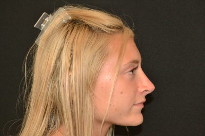 Rhinoplasty Before & After Patient #19843