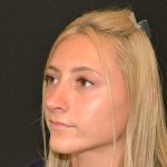 Rhinoplasty Before & After Patient #19843