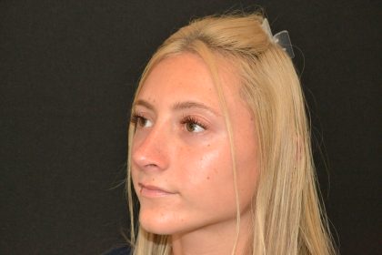 Rhinoplasty Before & After Patient #19843