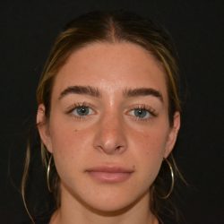 Revision Rhinoplasty Before & After Patient #19844