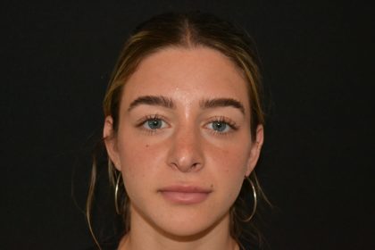 Revision Rhinoplasty Before & After Patient #19844