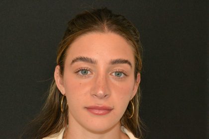 Revision Rhinoplasty Before & After Patient #19844