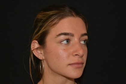 Revision Rhinoplasty Before & After Patient #19844