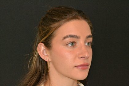 Revision Rhinoplasty Before & After Patient #19844