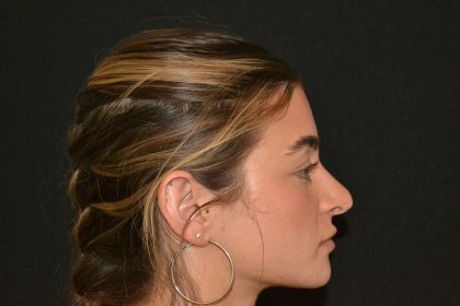 Revision Rhinoplasty Before & After Patient #19844