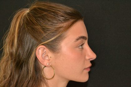 Revision Rhinoplasty Before & After Patient #19844