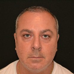 Rhinoplasty Before & After Patient #19845