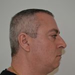 Rhinoplasty Before & After Patient #19845