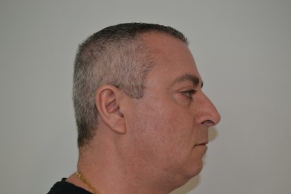 Rhinoplasty Before & After Patient #19845