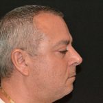 Rhinoplasty Before & After Patient #19845