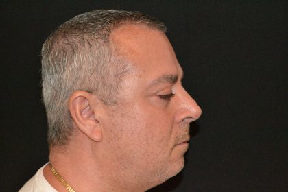 Rhinoplasty Before & After Patient #19845