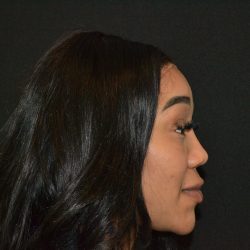 Rhinoplasty Before & After Patient #19846