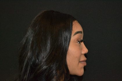 Rhinoplasty Before & After Patient #19846